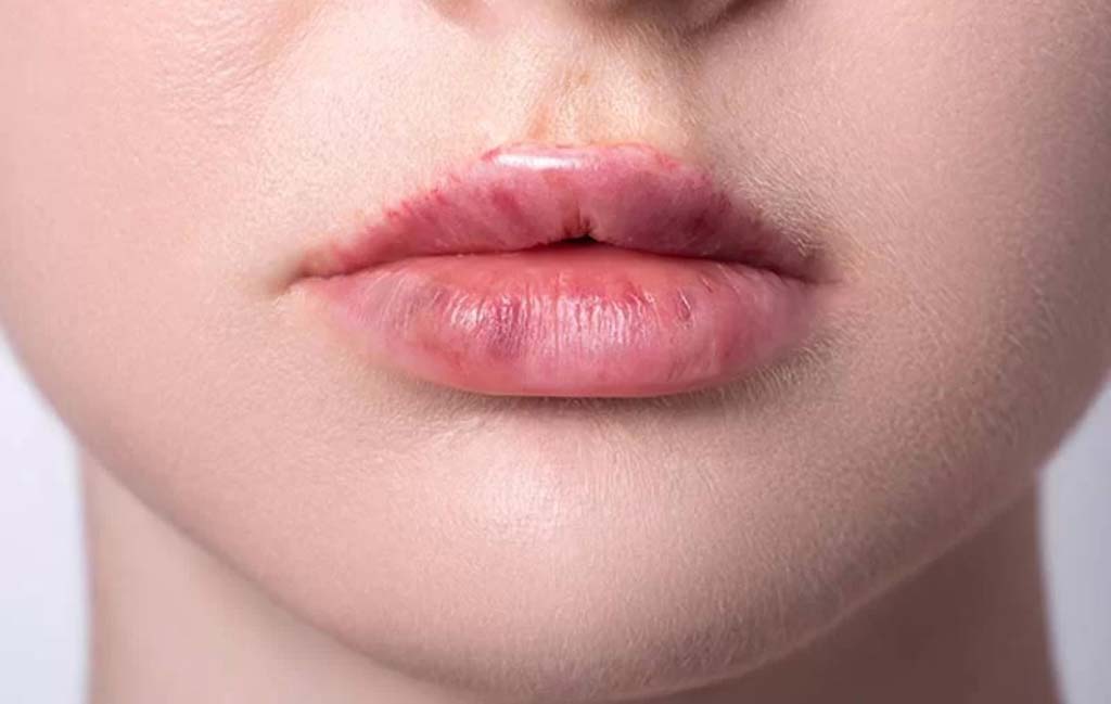 چه عواملی باعث افزایش احتمال کبودی لب بعد از تزریق ژل می‌شوند؟