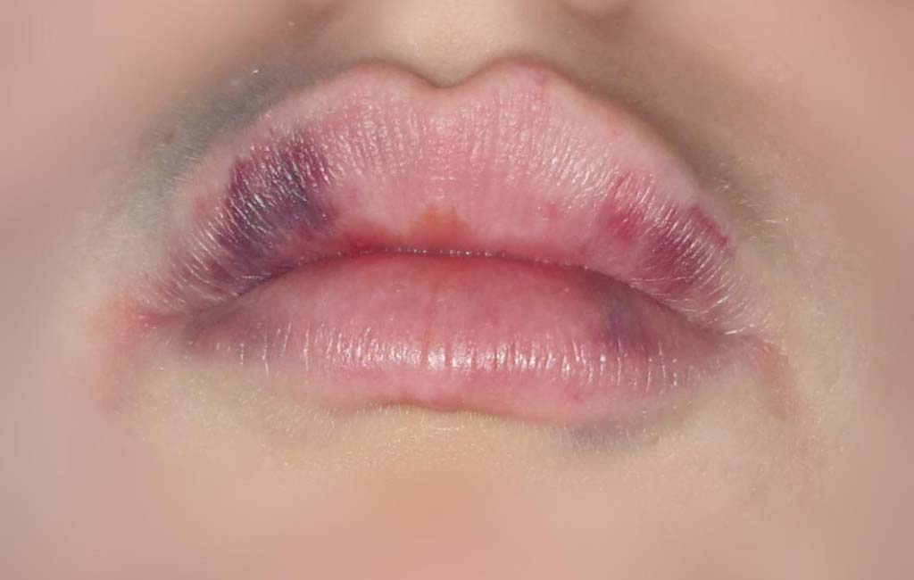 مراقبت های قبل و بعد از تزریق ژل لب برای کاهش کبودی لب