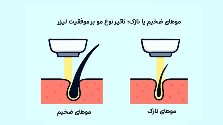 موهای ضخیم یا نازک؛ تاثیر نوع مو بر موفقیت لیزر